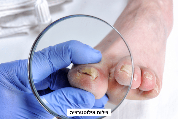 פטרת בציפורניים